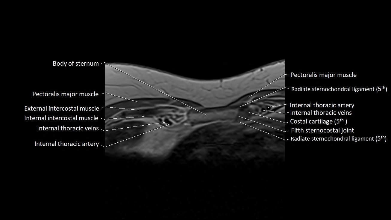 MRI sternum and sternoclavicular joint labeled axial anatomy image 27.webp